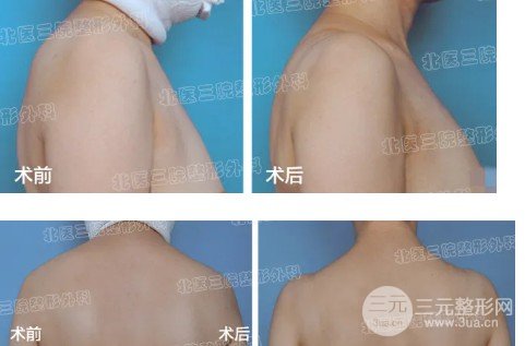 吸脂减肥价格贵不贵