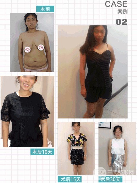 吸脂减肥价格贵不贵
