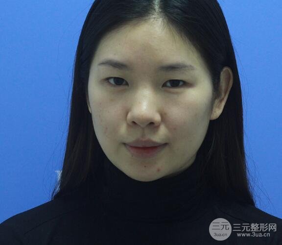 重庆park双眼皮手术反馈