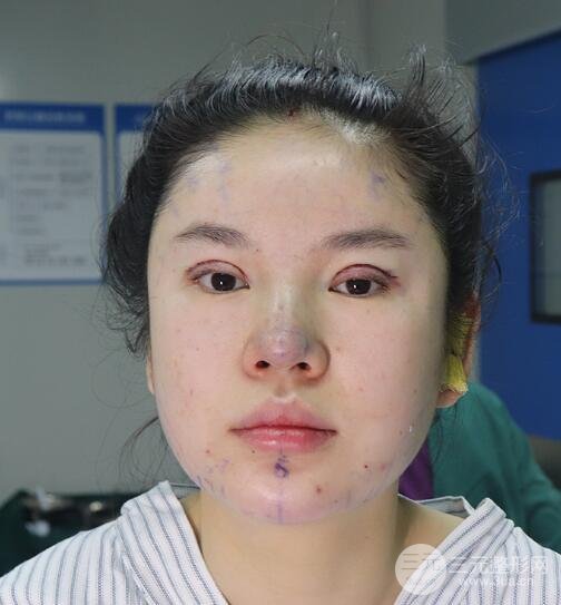 重庆park双眼皮手术反馈
