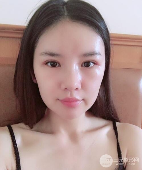 重庆park双眼皮手术反馈