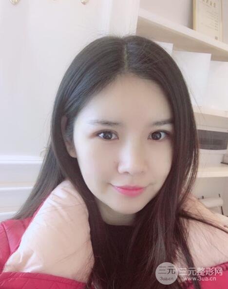 重庆park双眼皮手术反馈