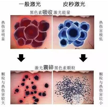 传统的蜂巢和激光仪器的区别