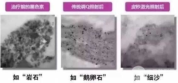 传统的蜂巢和激光仪器的缓解区别