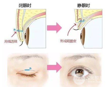 单眼皮埋线好还是割