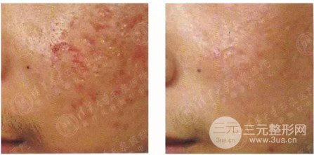 微针美容的大概费用