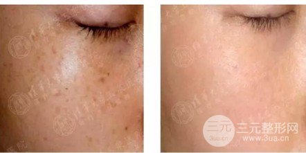 微针美容的大概费用