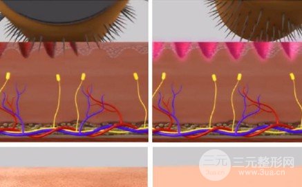 微针美容的大概费用