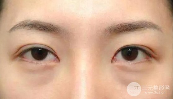 眼袋类型