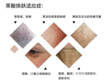 果酸换肤是什么