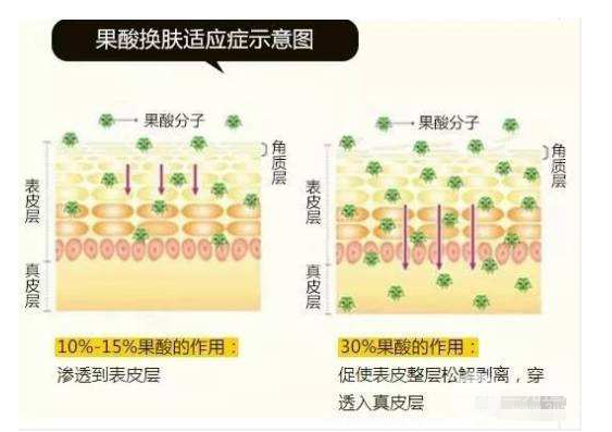 果酸换肤是什么