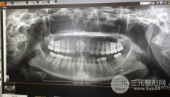 口腔种植牙流程：种牙一共有几个步骤?