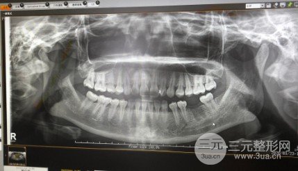 口腔种植牙流程