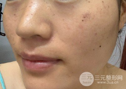 祛斑大概多少钱