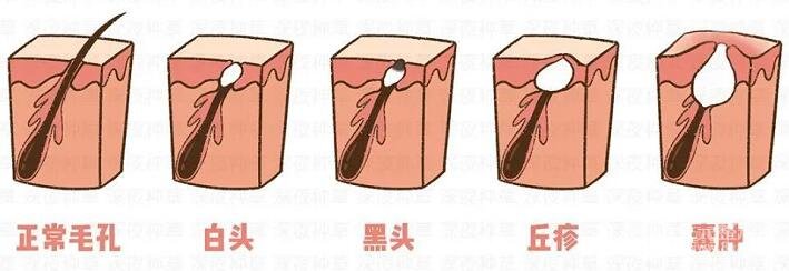 痘痘有几种类型?