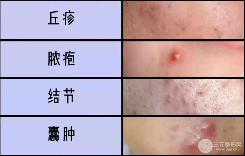 痘痘有几种类型?