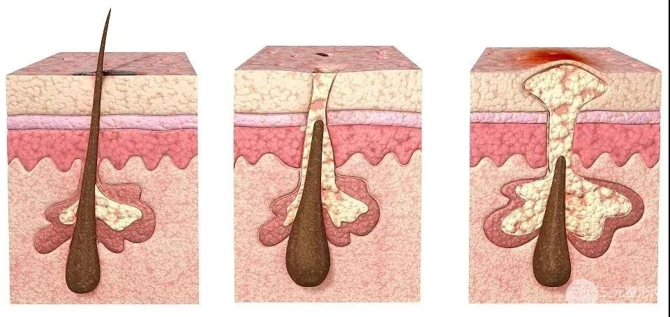 天选长痘之人也能让痘痘无处可逃退避三舍！