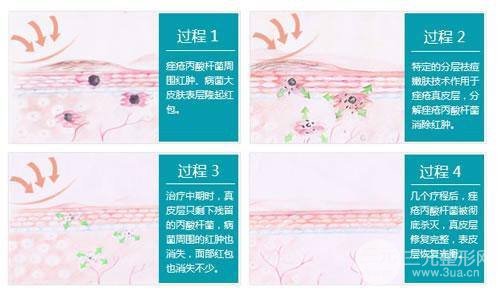 痤疮