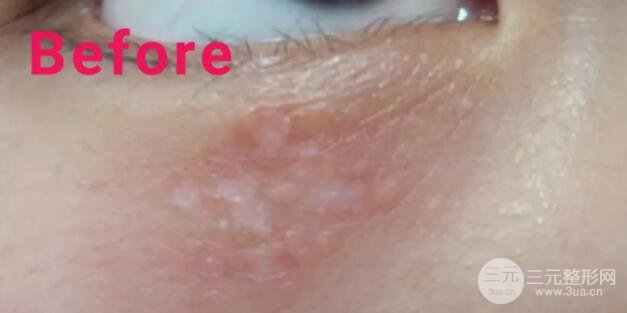 大家可以直观的看到脂肪粒被祛除的过程