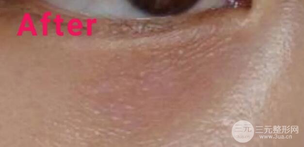 大家可以直观的看到脂肪粒被祛除的过程