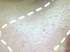 脂肪粒|停用眼霜真的有用吗？该怎么缓解？