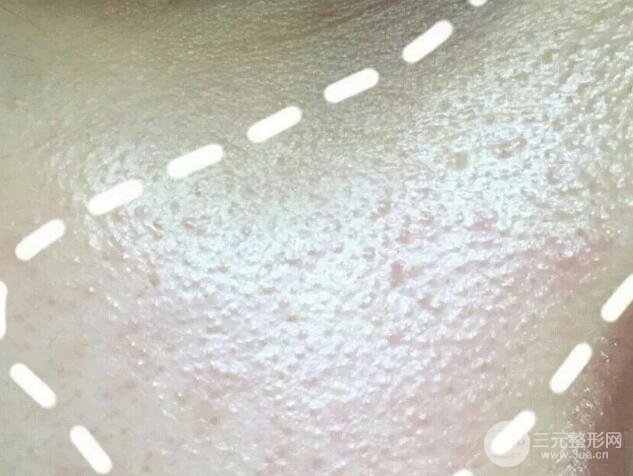 脂肪粒的自白:停用眼霜真的有用吗?