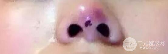 扒皮|让你交智商税的医美项目：离子微创去眼袋