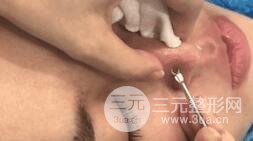 第二步、就是针清啦