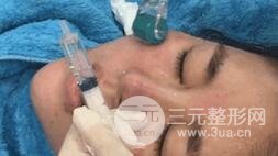 第四步，全脸微针