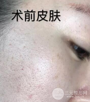 第四步，全脸微针