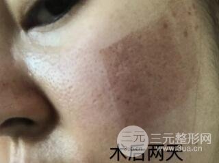 第四步，全脸微针