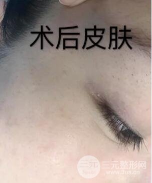 第四步，全脸微针