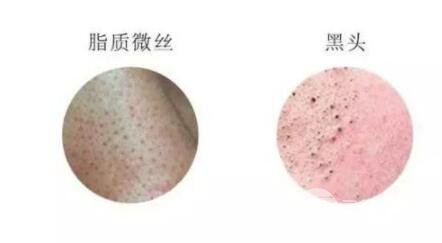 顽固黑头:黑头心中刺,拔掉万般难!