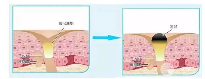 顽固黑头:黑头心中刺,拔掉万般难!