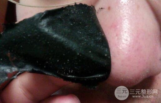 顽固黑头:黑头心中刺,拔掉万般难!