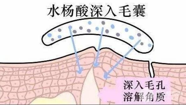顽固黑头:黑头心中刺,拔掉万般难!