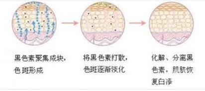 去除脸上黄褐斑有哪些方法?成好吗?