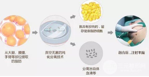 隆胸好吗