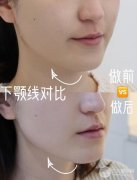 热玛吉|28岁的你还没听说过？让众多明星都打call的抗衰项目科普来了！