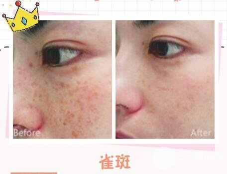 光子嫩肤的常见问题