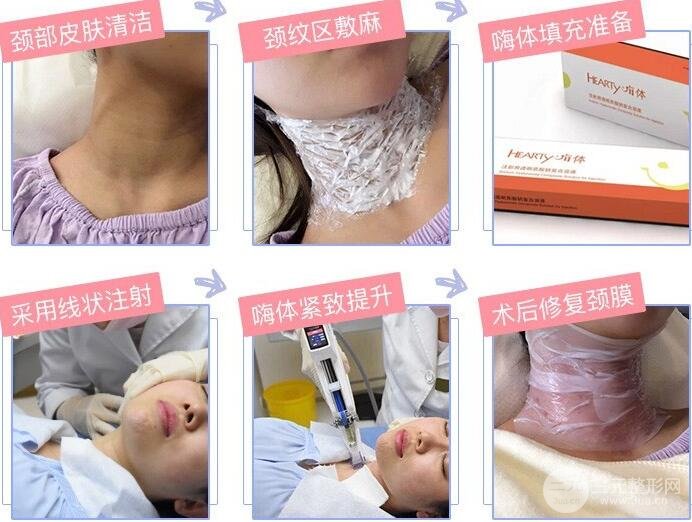 嗨体去颈纹
