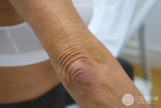 图：纤维凝胶注射前肘部皱纹