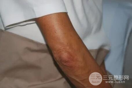 图：第一次注射后1个月