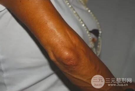 图：第三次注射后6个月