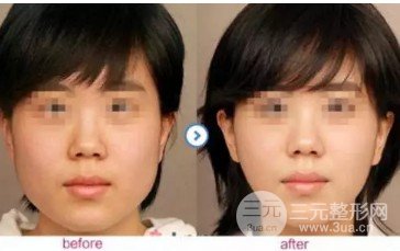 打****注射瘦脸的价格贵吗