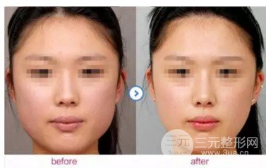 打****注射瘦脸的价格贵吗