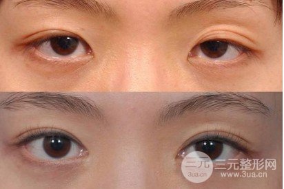上睑下垂怎么办