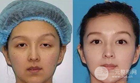 上睑下垂怎么办