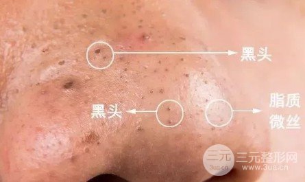 鼻子长黑头怎么办