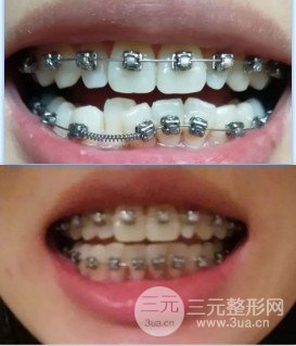 整牙齿多少钱